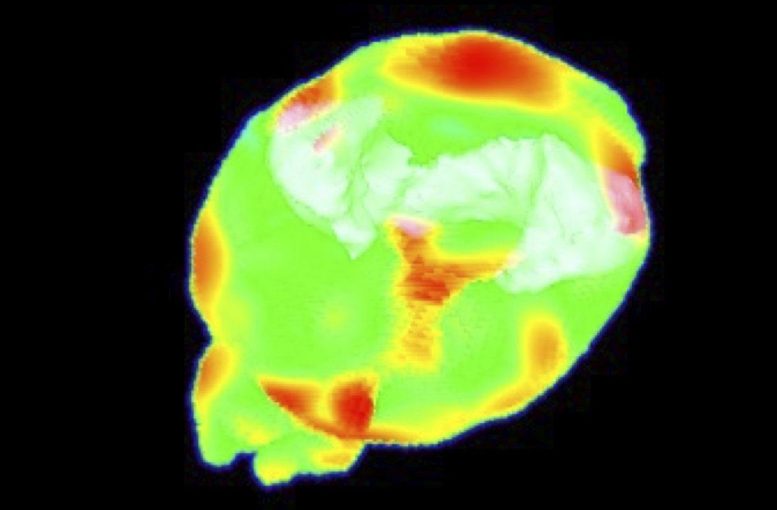 How APOE4 Affects Brain Lipids and Inflammation