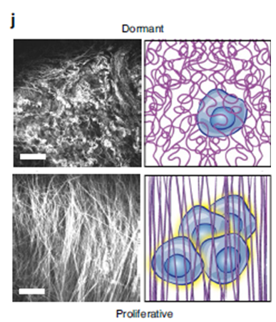 New breakthrough: This collagen can make tumor cells go dormant!